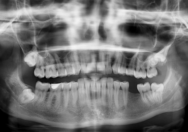 Prótesis dentales, la mejor opción cuando tus dientes fallan