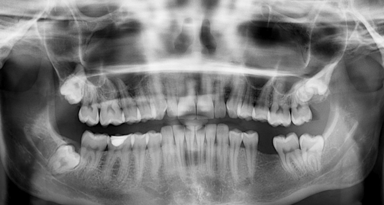 Prótesis dentales, la mejor opción cuando tus dientes fallan