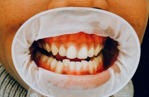 ¿Qué son los dientes supernumerarios o hiperdoncia?