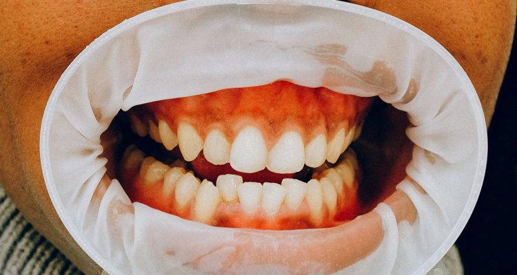¿Qué son los dientes supernumerarios o hiperdoncia?