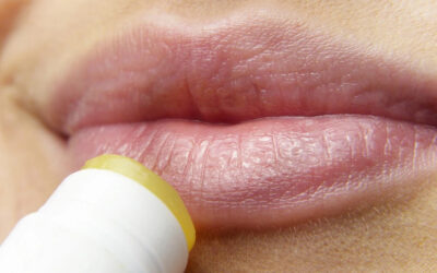 ¿Qué debes saber del herpes oral?